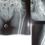 Arthritis of Both Hips