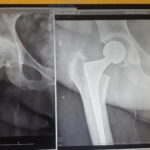 Hip Replcement Before and After Front