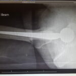 Hip Replcement Side