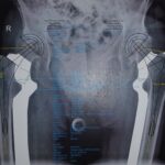 Planning of Hip Replacement