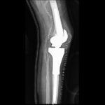 Proximal tibia replacement Lateral